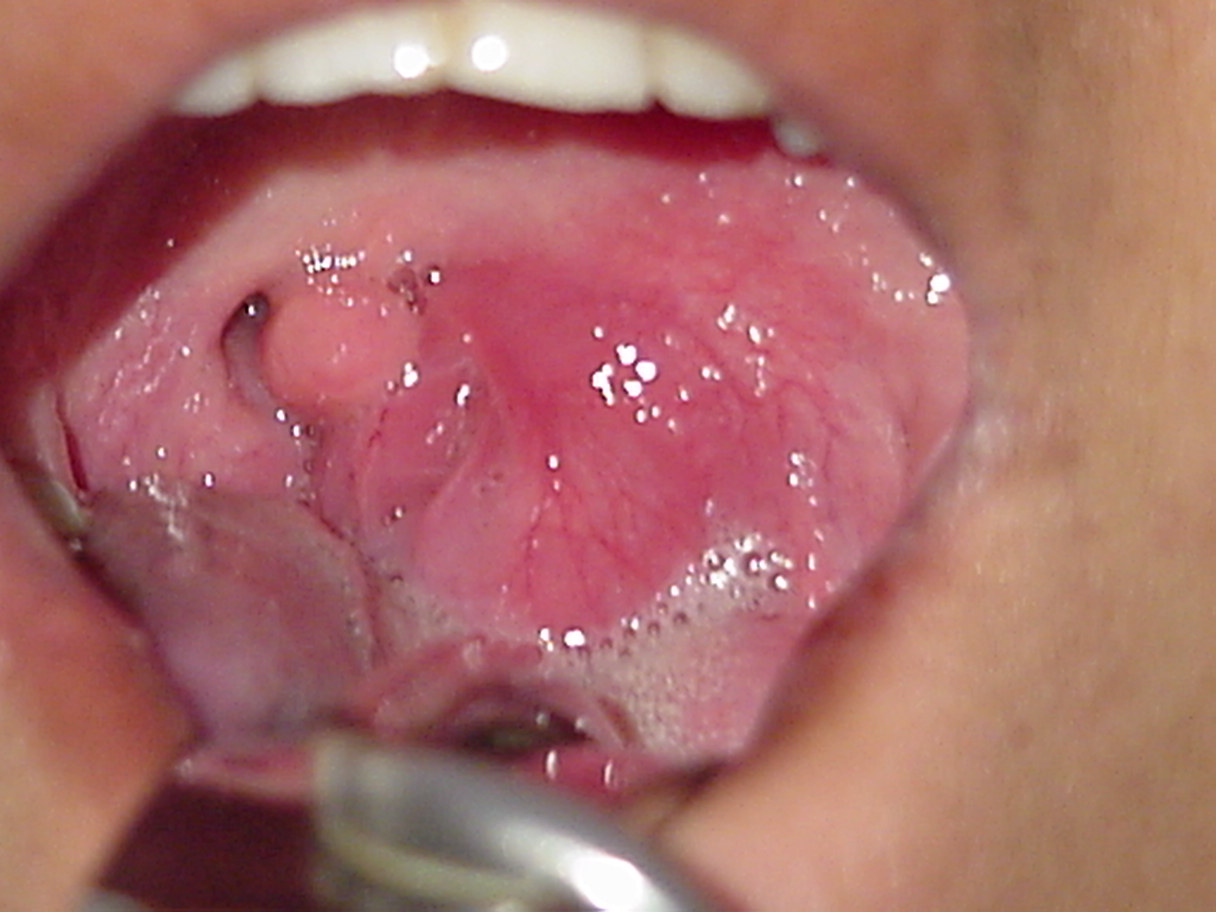 ENT, Otolaryngology, Quinsy, Peritonsillar Abscess, Throat - Quinsy Patient